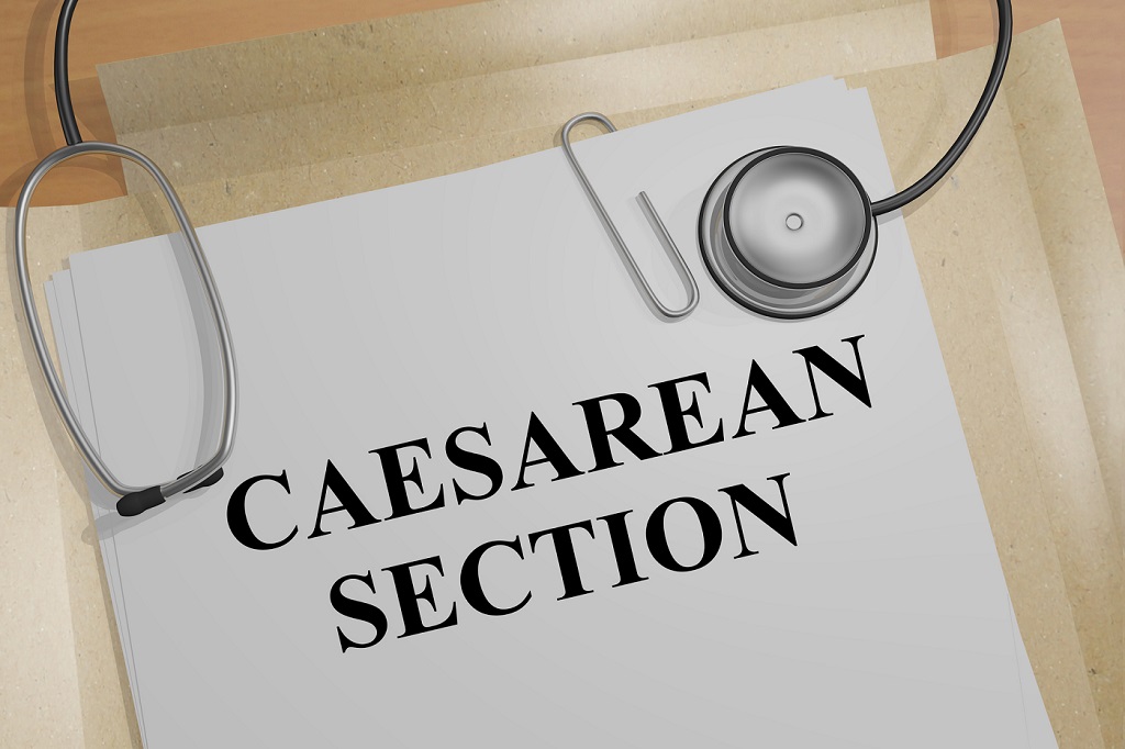 Caesarean Section Twins