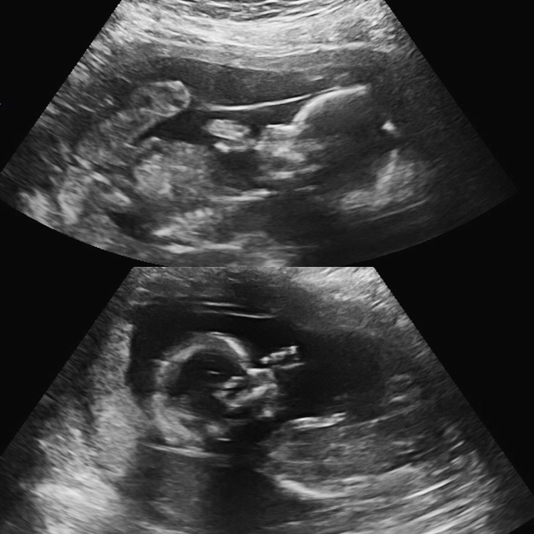 Ultrasound of twin sex